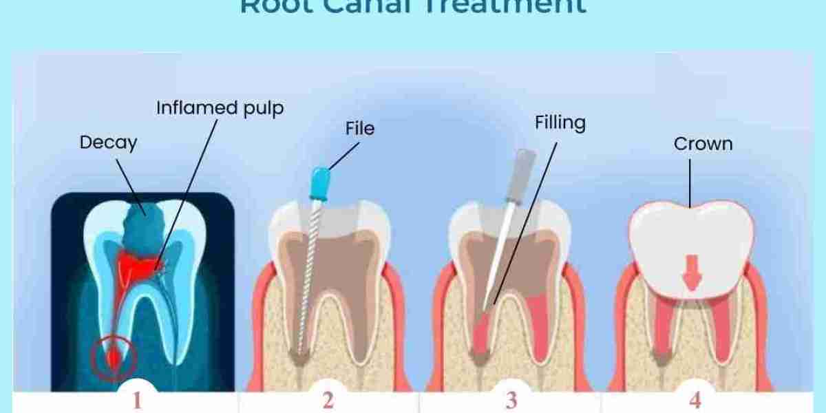 Don’t Suffer: Discover Painless Root Canal Treatment in Hoodi Bangalore